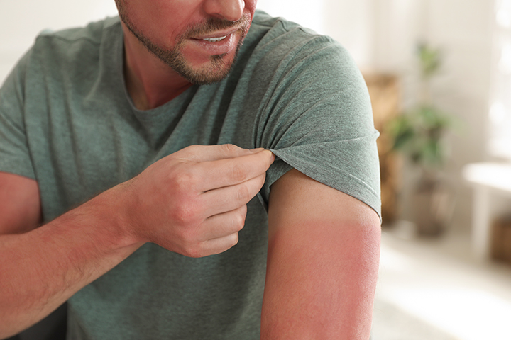 Man with a sunburned arm 