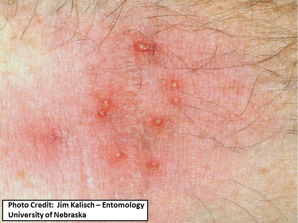 oak leaf itch mite bites